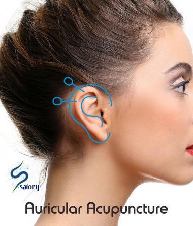 Auricular acupuncture